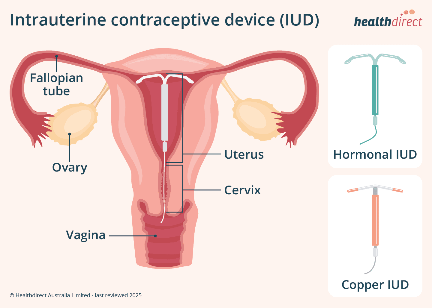 UK guidance clarifies contraception, ovulation and HRT in perimenopause