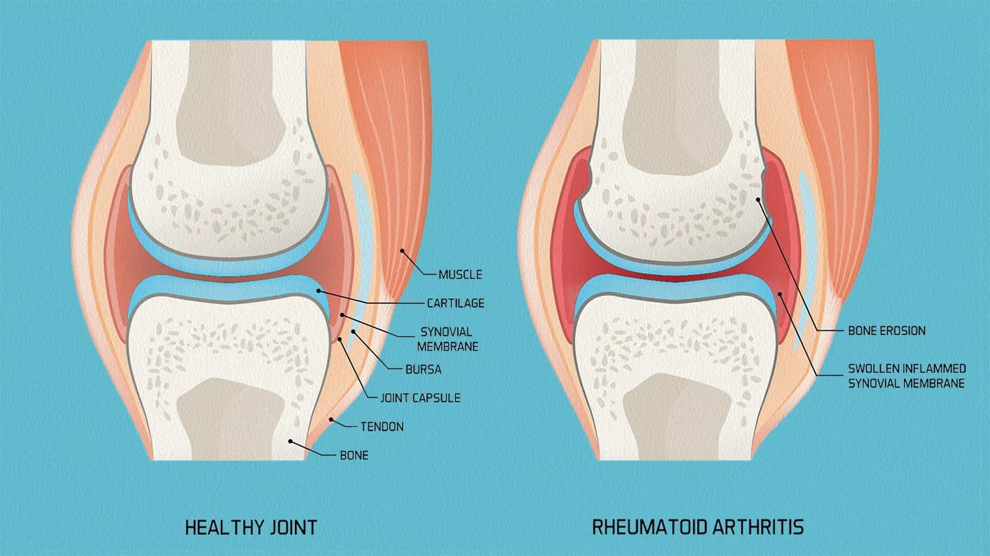 New study will measure menopause’s musculoskeletal burden in England